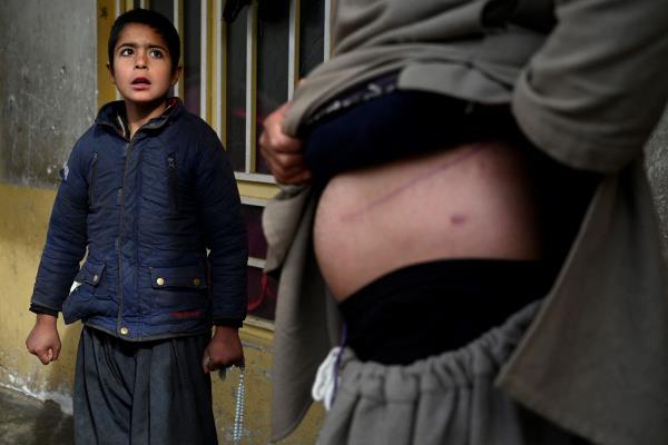  In this photo taken on Feb. 4, 2022, Nooruddin, who sold his kidney to raise mo<em></em>ney for his family, shows the scars from the operation, next to his son Javid at their house in the Khwaja Koza Gar area in Herat.